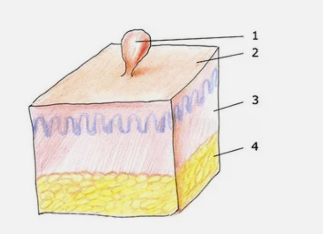 Papilomas en el cuerpo humano